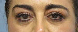 Blepharoplasty