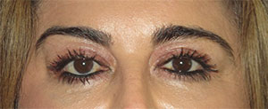 Blepharoplasty