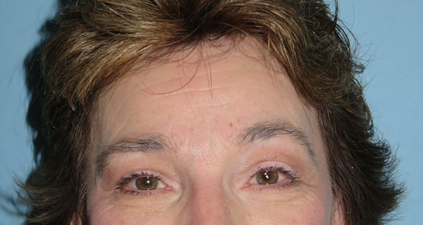 Brow Lift