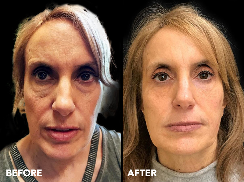 Before and After Image of Liquid Facelift Scottsdale