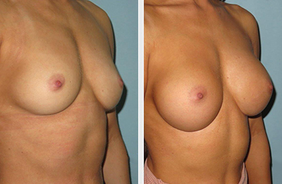 Breast Procedures