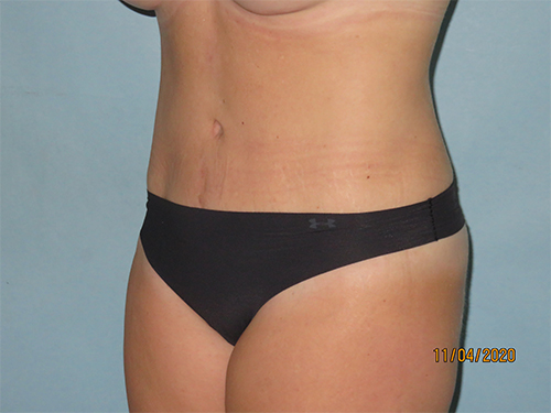 Tummy Tuck