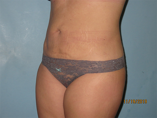 Tummy Tuck