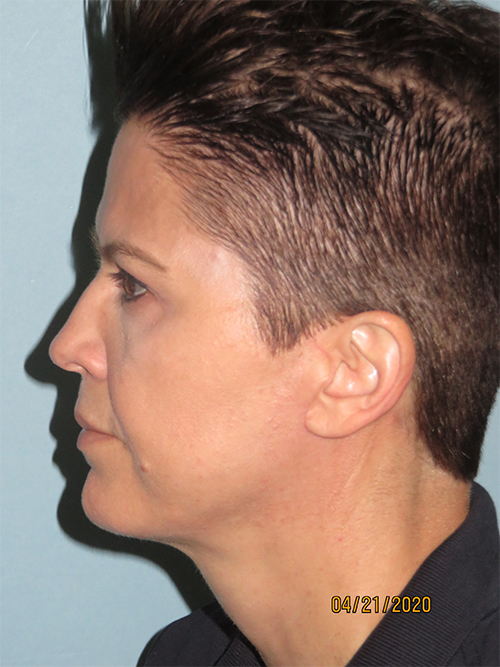 Facelift