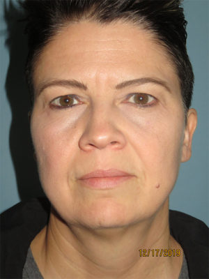 Blepharoplasty