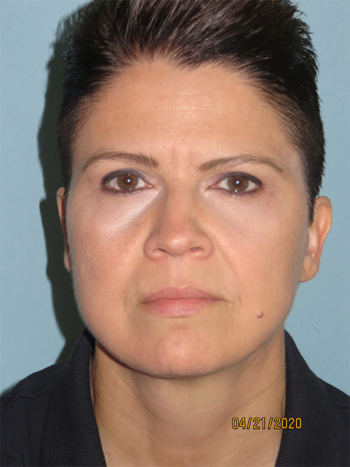 Facelift
