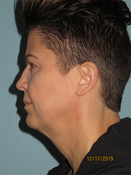Facelift