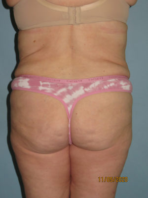 Liposuction