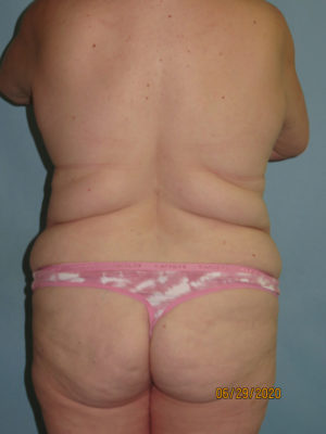 Liposuction