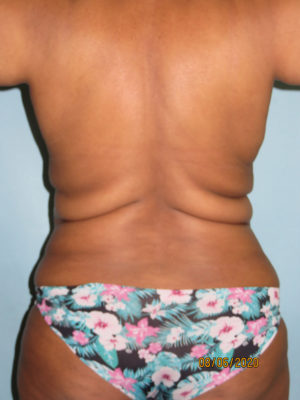 Liposuction