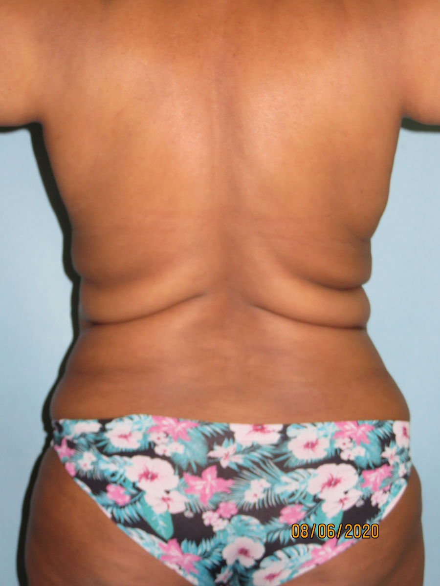 Liposuction