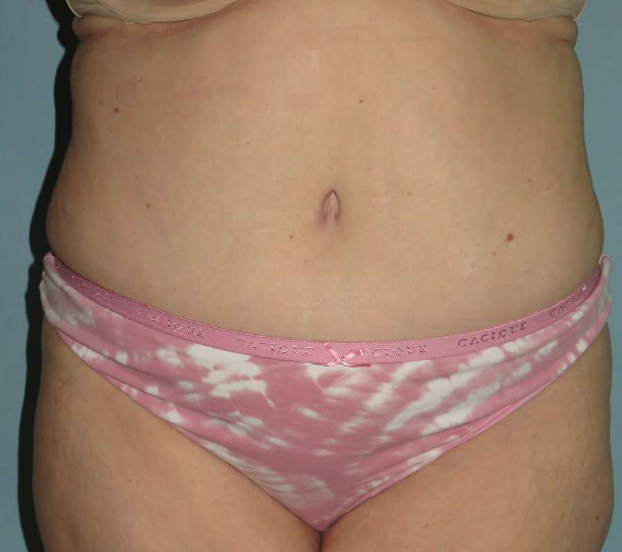 Tummy Tuck