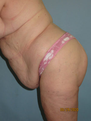 Tummy Tuck