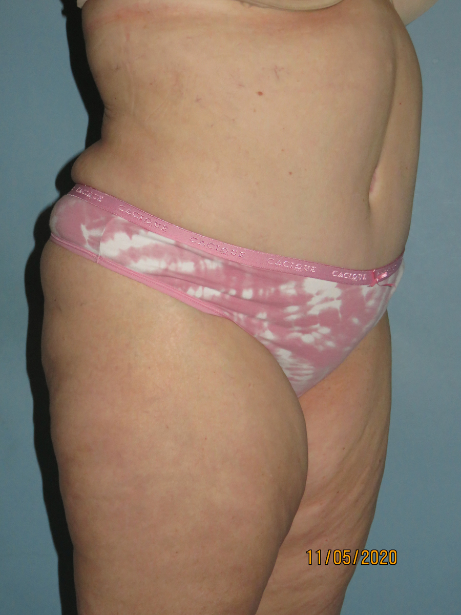 Tummy Tuck