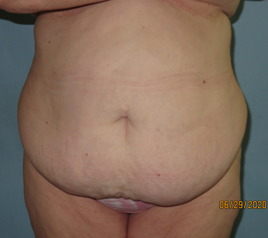 Tummy Tuck