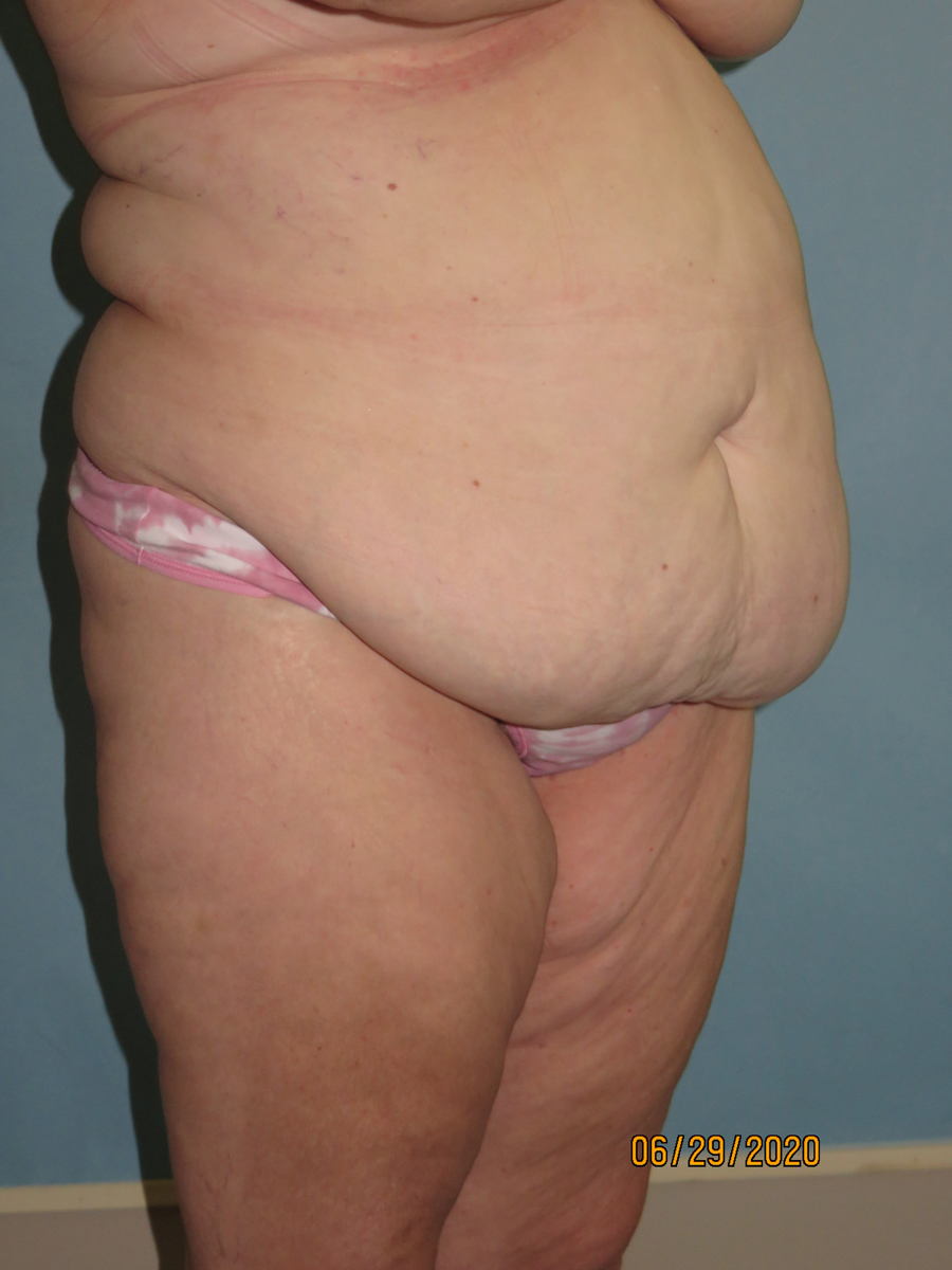 Tummy Tuck