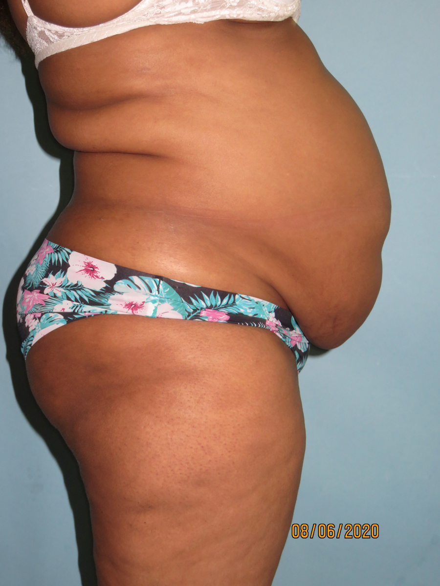 Tummy Tuck