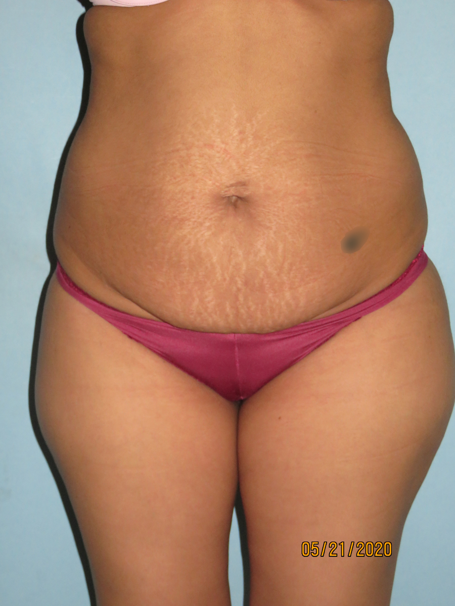 Tummy Tuck