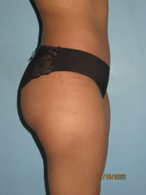 Tummy Tuck