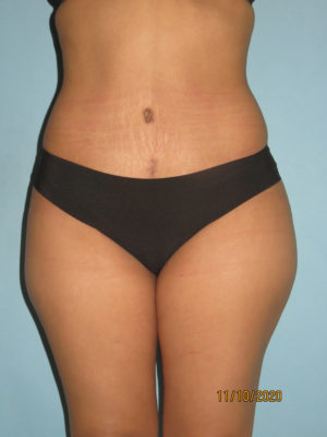 Tummy Tuck