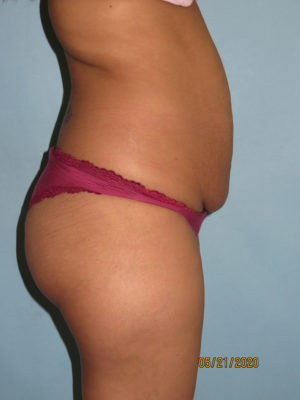 Tummy Tuck