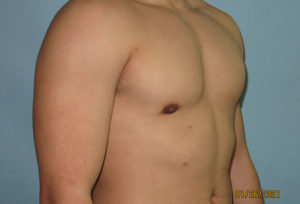 Male Breast Reduction - Gynecomastia