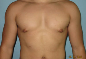 Male Breast Reduction - Gynecomastia