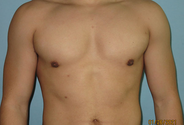 Male Breast Reduction - Gynecomastia