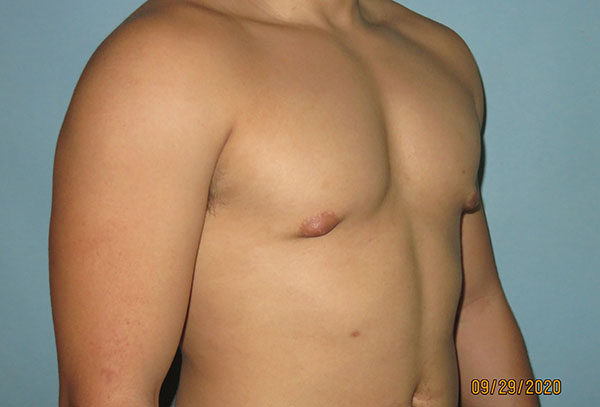 Male Breast Reduction - Gynecomastia