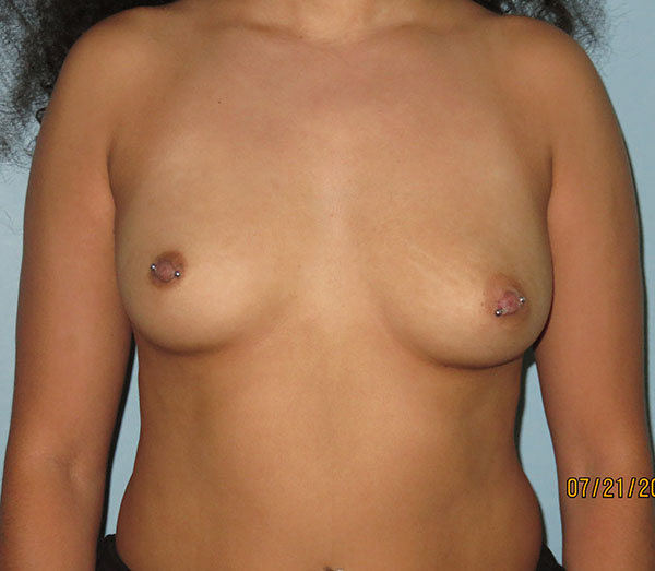 Breast Augmentation