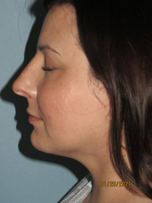 Neck Liposuction