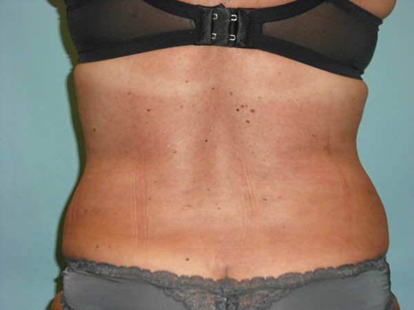 Liposuction