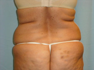 Liposuction