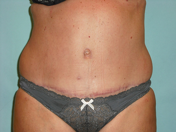 Tummy Tuck