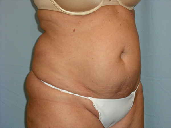 Tummy Tuck