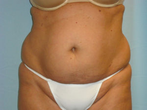 Tummy Tuck