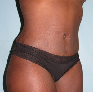 Tummy Tuck