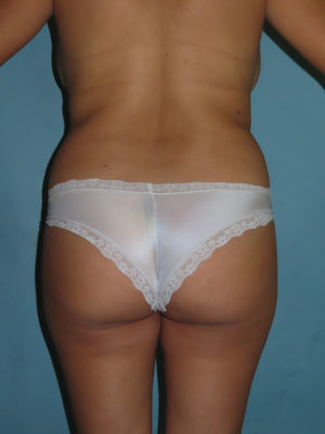 Liposuction