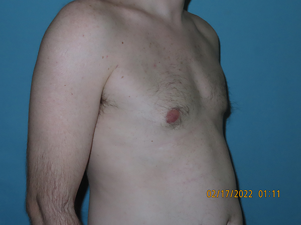 Male Breast Reduction - Gynecomastia