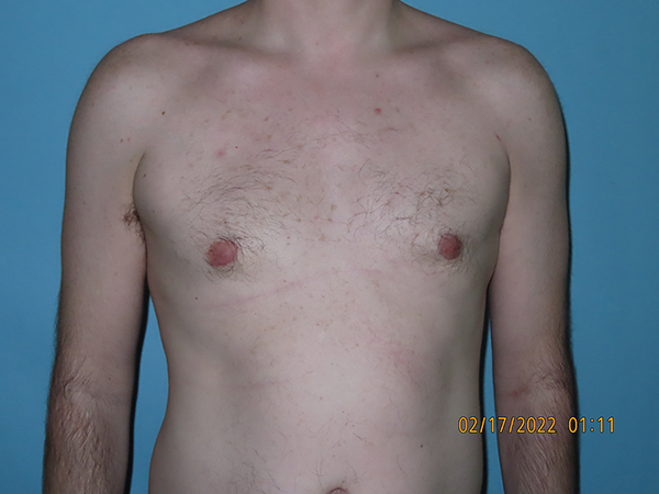 Male Breast Reduction - Gynecomastia