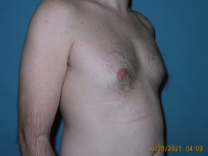 Male Breast Reduction - Gynecomastia