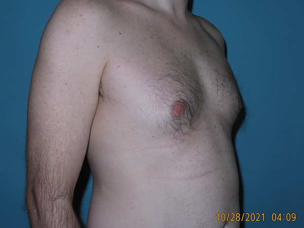 Male Breast Reduction - Gynecomastia
