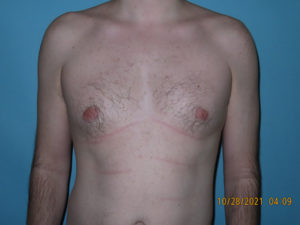 Male Breast Reduction - Gynecomastia