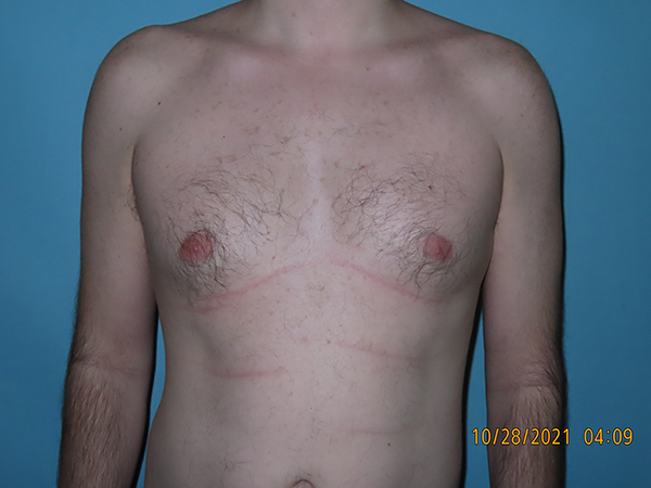 Male Breast Reduction - Gynecomastia