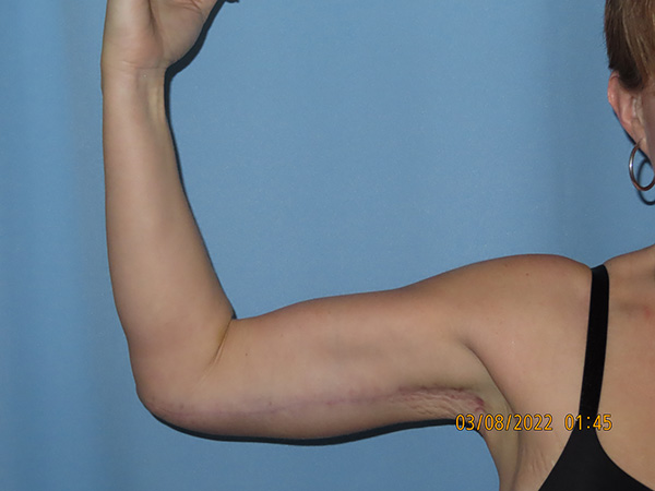 Brachioplasty (Arm Lift)