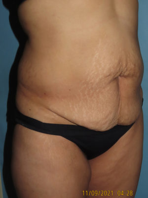 Tummy Tuck