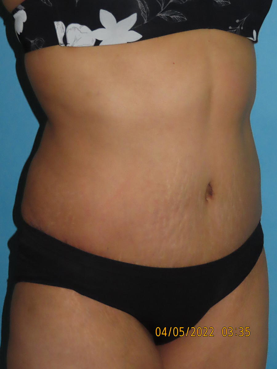 Tummy Tuck