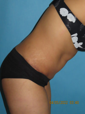 Tummy Tuck