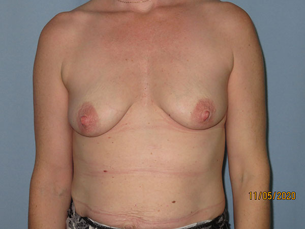 Breast Lift (Mastopexy)