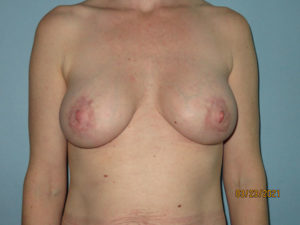 Breast Lift (Mastopexy)